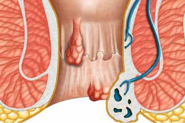 Fistula in Ano Treatment in Pune, India- Kaizen Fistula Care