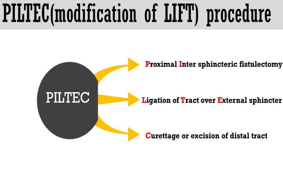 PILTEC procedure